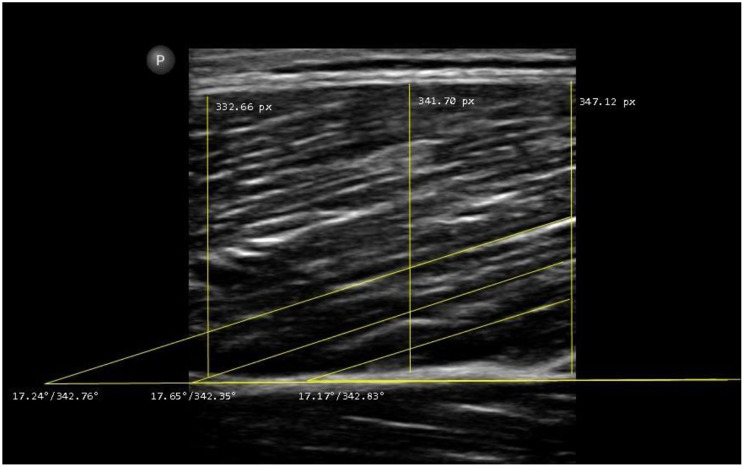 Examiner experience moderates reliability of human lower extremity muscle ultrasound measurement - a double blinded measurement error study.