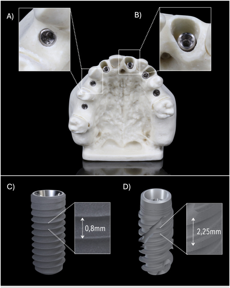 Primary implant stability of two implant macro-designs in different alveolar ridge morphologies: an in vitro study.