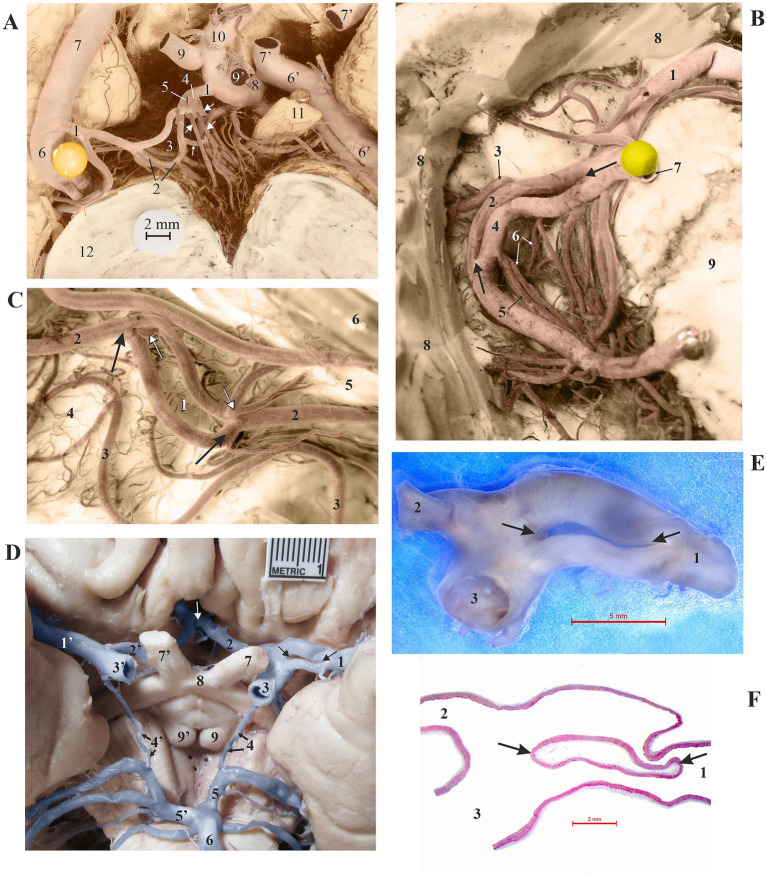 Fenestrations of cerebral arteries and their correlation with brain aneurysms.
