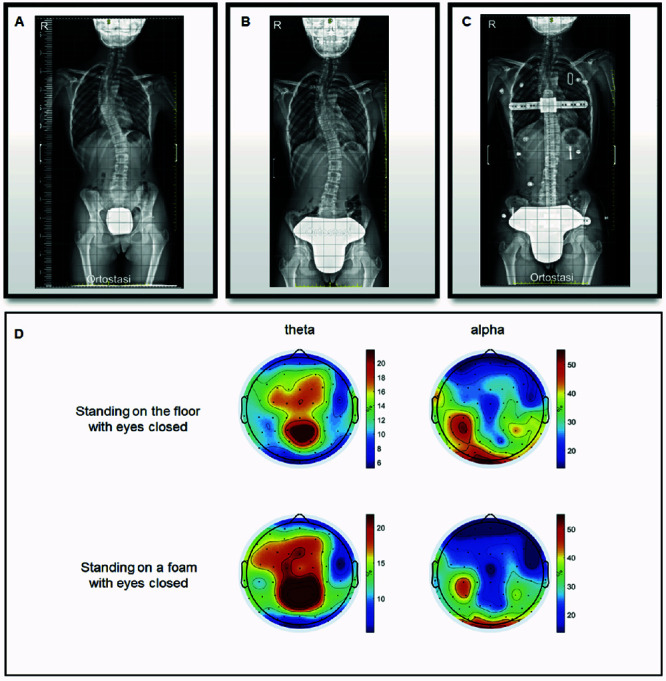 A neurophysiological and genetic assessment of a case of rapidly progressive scoliosis.