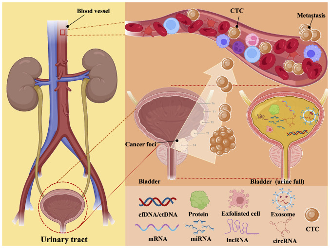 Unleashing the power of urine‑based biomarkers in diagnosis, prognosis and monitoring of bladder cancer (Review).