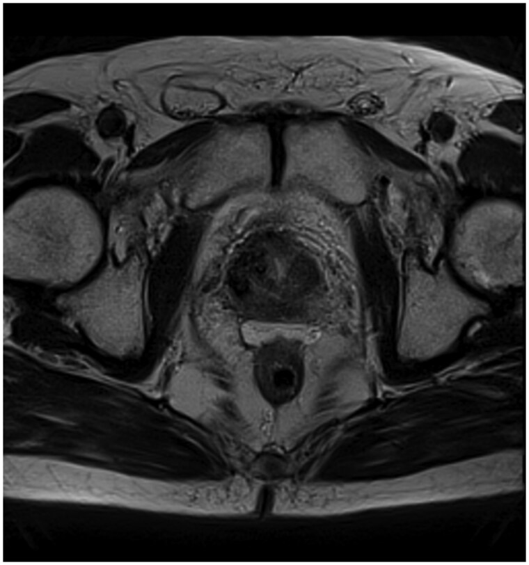 Rectal complications following SpaceOAR insertion after prior pelvic radiation.