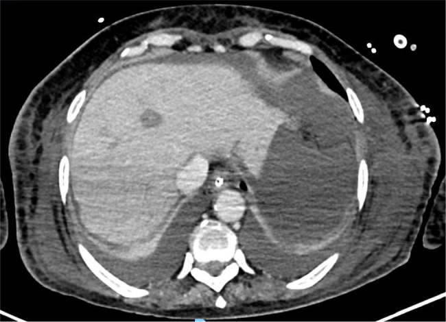 Malignancy can Present as Acute Liver Failure - A Case Report of B-Cell Lymphoma with Acute Liver Failure as its First Presentation.