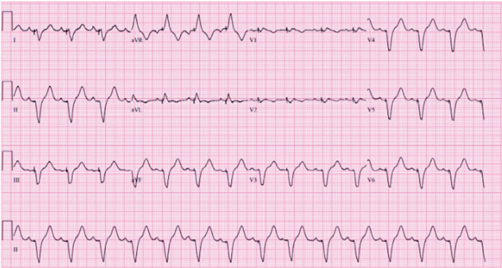 Immune Checkpoint Inhibitor-induced Myocarditis: A Case Report of Complete Heart Block and Challenges in a Patient on Pembrolizumab.