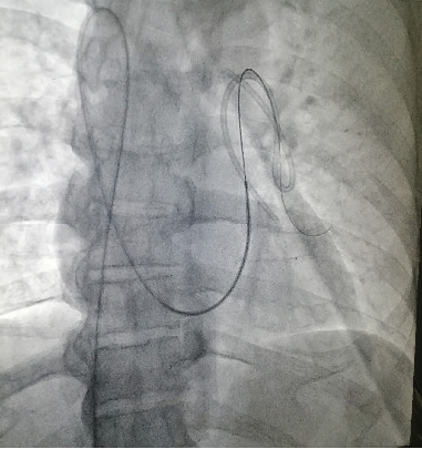 A Rare Case of Dislodged Chemoport Catheter Entrapment in the Pulmonary Artery.