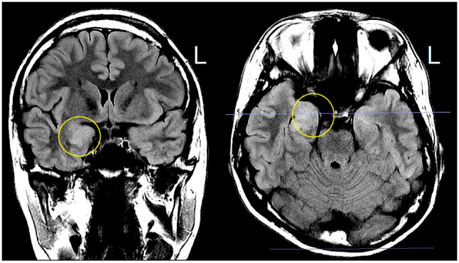 Glutamic acid decarboxylase antibody-spectrum disorders and type 1 diabetes mellitus in a patient following allogenic hematopoietic cell transplantation with review of literature.