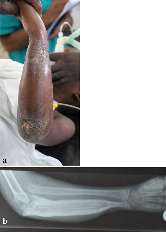 Osteomyelitis and Septic Arthritis of the Upper Extremity in Pediatric Patients.