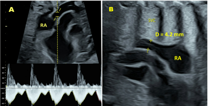 Superior vena cava blood flow and Doppler indices of brain sparing in late onset fetal growth restriction.