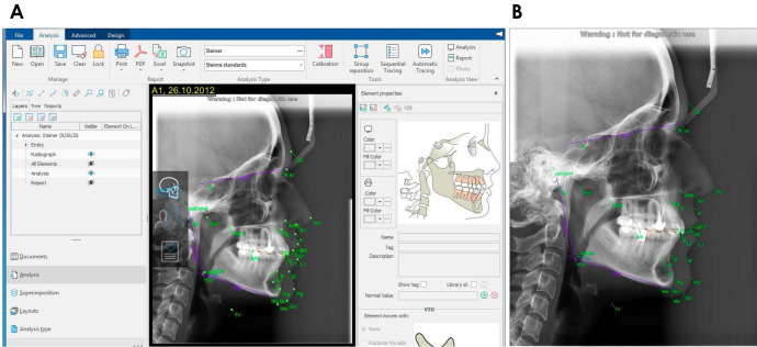 Comparative accuracy of artificial intelligence-based AudaxCeph software, Dolphin software, and the manual technique for orthodontic landmark identification and tracing of lateral cephalograms.