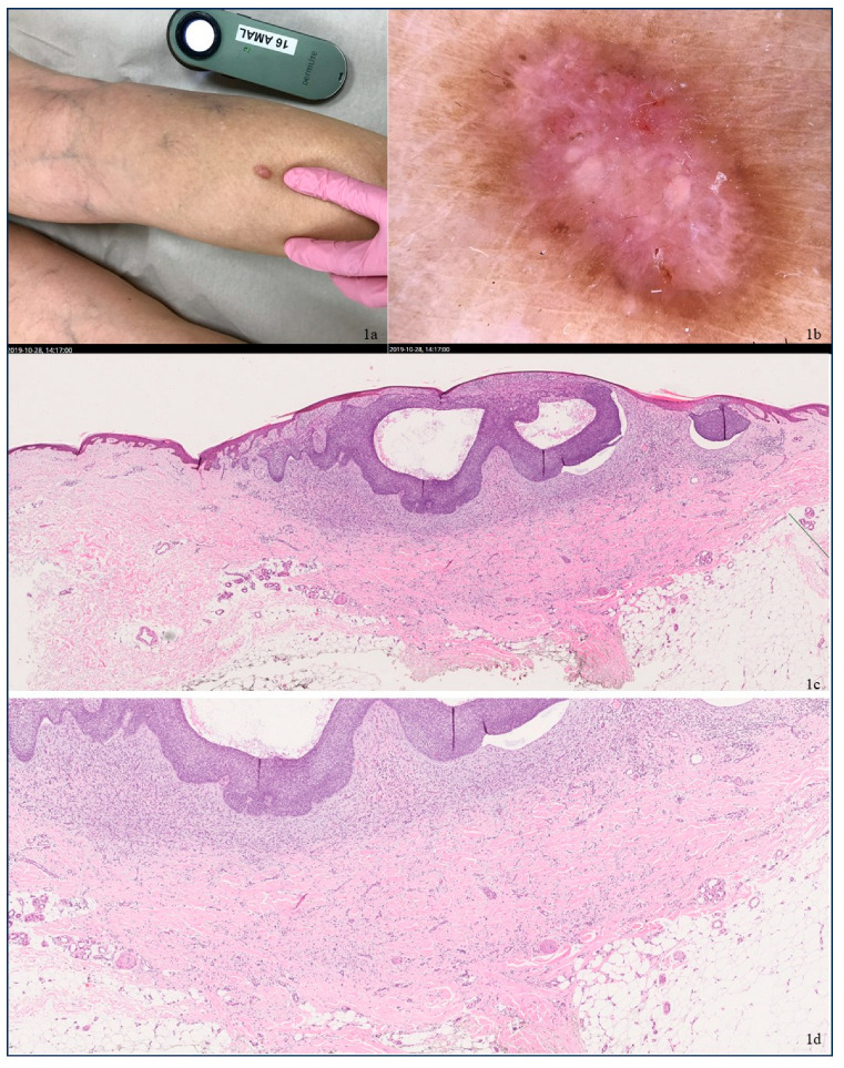 Uncommon Collision Tumors: Dermoscopic and Histopathological Features of Basal Cell Carcinoma Overlying Dermatofibroma.