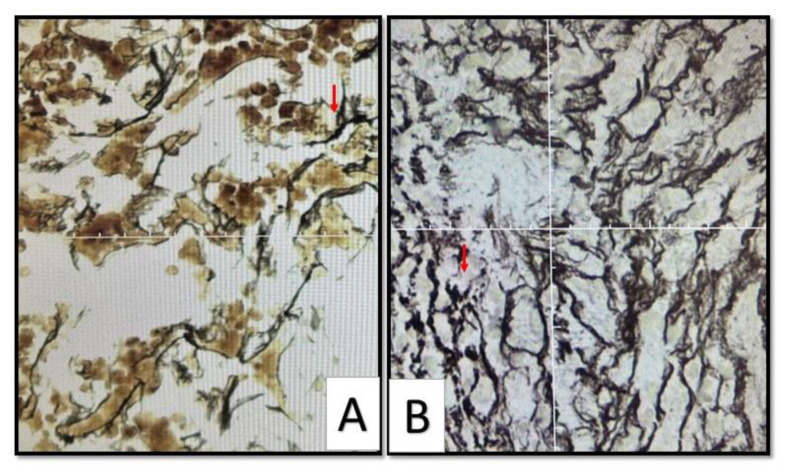 Co-Occurrence of Jak2-Positive Myelofibrosis and Bcr-Abl-Positive Chronic Myelogenous Leukaemia Treated with Combination of Tyrosine Kinase Inhibitors and Ruxolitinib.