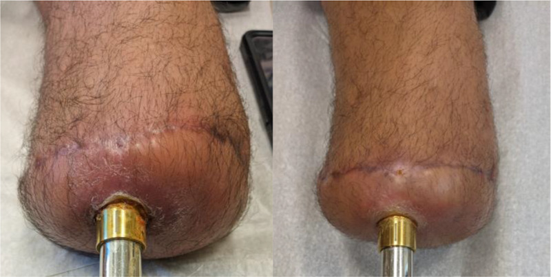 Consensus statement on the prevention, diagnosis, and management of infection following transcutaneous osseointegration for patients with limb loss: current state-of-the-art and proposed future studies.