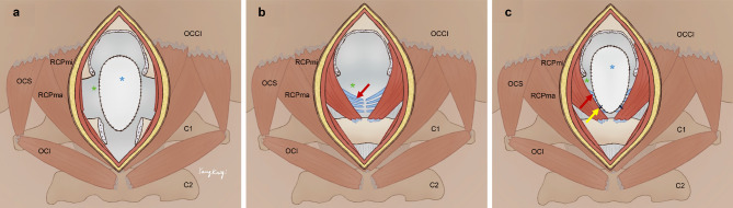 A new concept and surgical approach for Chiari malformation type I based on the protection and strengthening of the myodural Bridge.