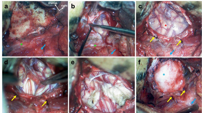 A new concept and surgical approach for Chiari malformation type I based on the protection and strengthening of the myodural Bridge.
