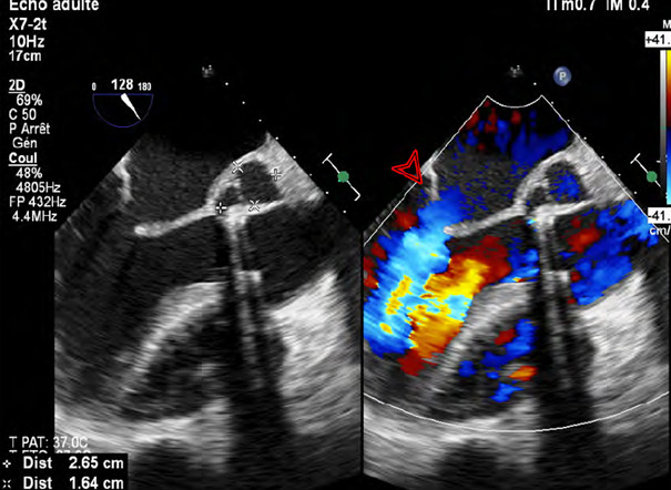 [A case of brucella endocarditis in Tunisia].