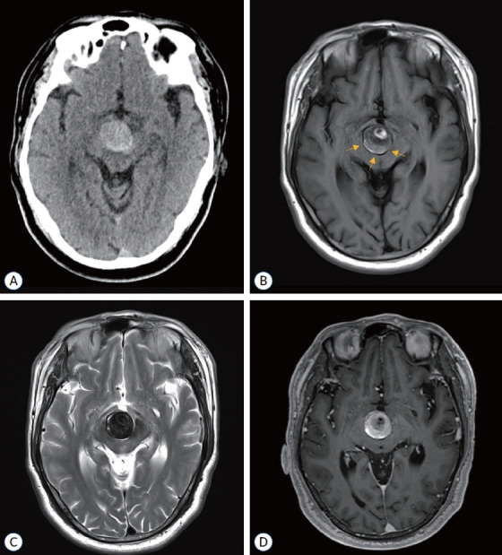 Strategic Dual Approach for the Management of a Symptomatic Giant Partially Thrombosed Aneurysm at the Basilar Tip - Integrating Intrasaccular Flow Diversion and Endovascular Flow Reversal.
