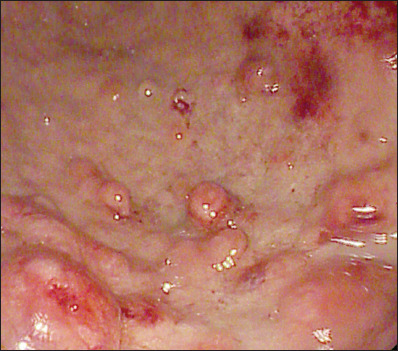 Effective endoscopic management of gastric neoplastic complications in patients with autoimmune gastritis: results of a monocentric study of 88 patients.