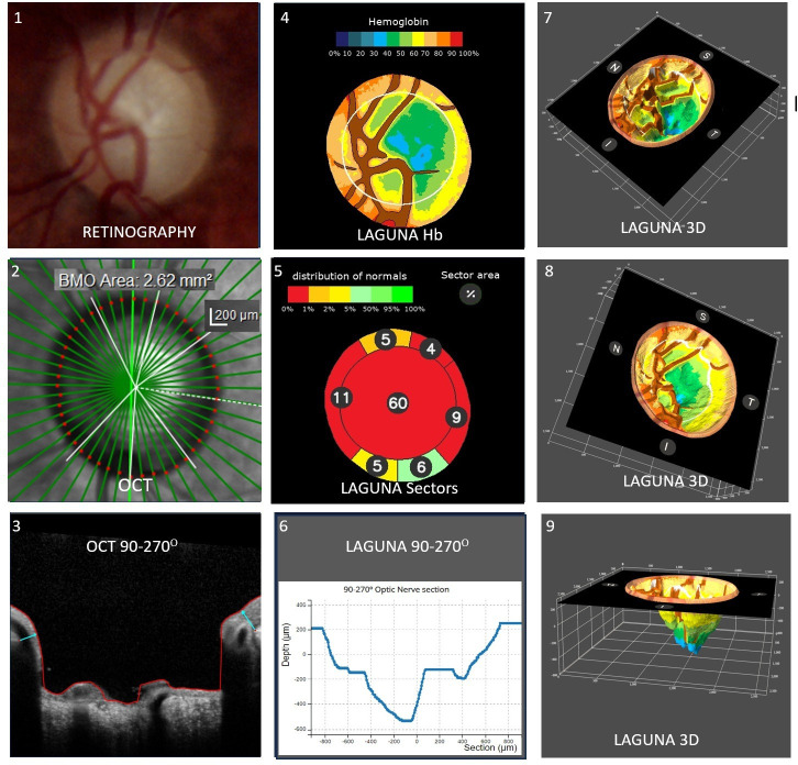 Estimation of normal and glaucomatous optic nerve morphology from perfusion.