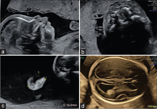 Monogenic Syndromes: The Need for Clinical Vigilance in Fetuses with Pierre Robin Sequence in the Era of Noninvasive Prenatal Screening.