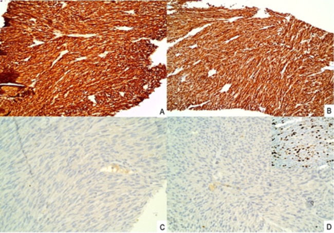 Cytological Diagnosis of Hepatic Metastasis from Rectal Gastrointestinal Stromal Tumor: A Case Report.