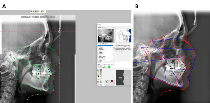 Comparative accuracy of artificial intelligence-based AudaxCeph software, Dolphin software, and the manual technique for orthodontic landmark identification and tracing of lateral cephalograms.