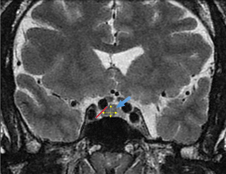 Evaluation of pituitary tumor volume as a prognostic factor in acromegaly: A cross-sectional study in two centers.