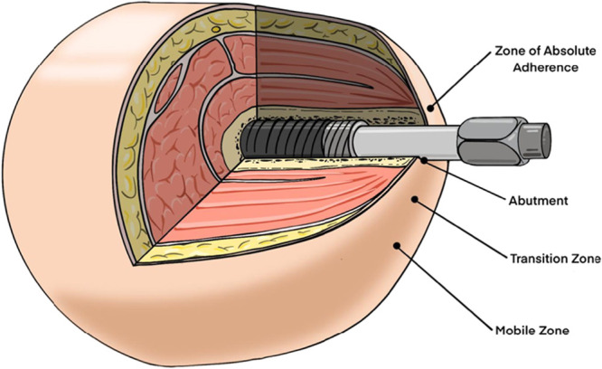 A conceptual framework for soft tissue management of transdermal bone-anchored implants in extremity prostheses.