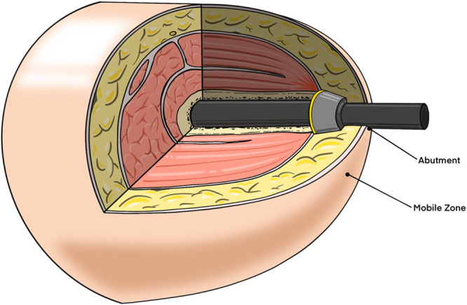 A conceptual framework for soft tissue management of transdermal bone-anchored implants in extremity prostheses.