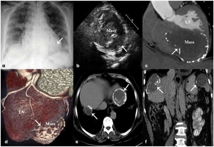 Multimodality Imaging Assessment of a Multi-Organ Hydatid Cyst
