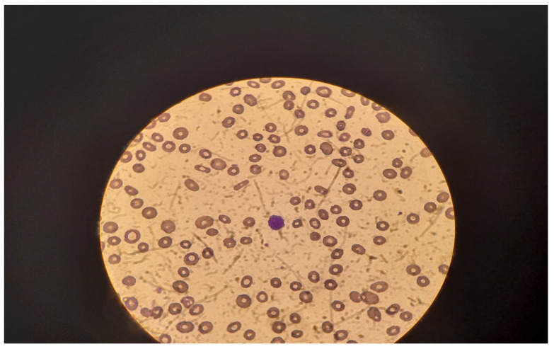 Hairy Cell Leukemia: A Differential Diagnosis of Hepatitis B-Associated Aplastic Anemia and Syphilis.