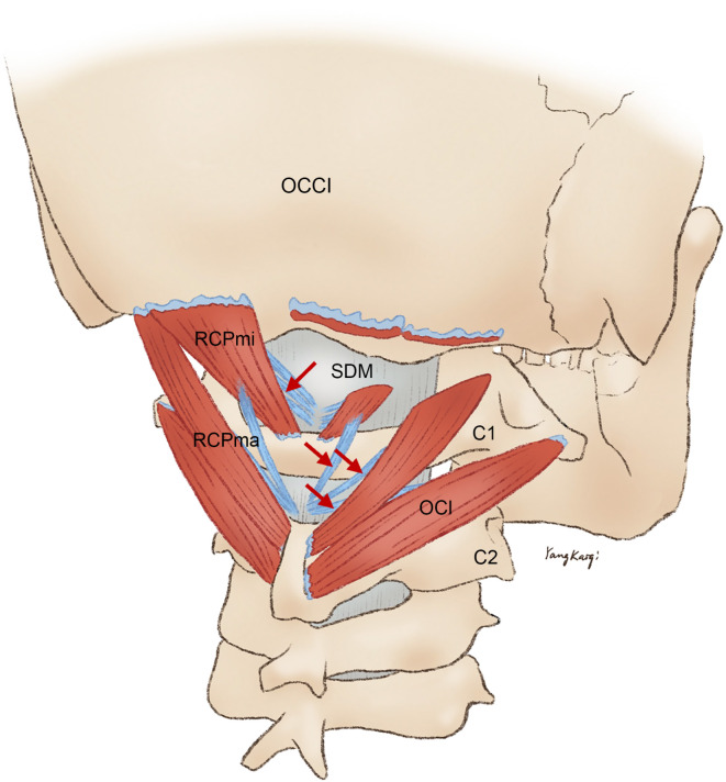 A new concept and surgical approach for Chiari malformation type I based on the protection and strengthening of the myodural Bridge.