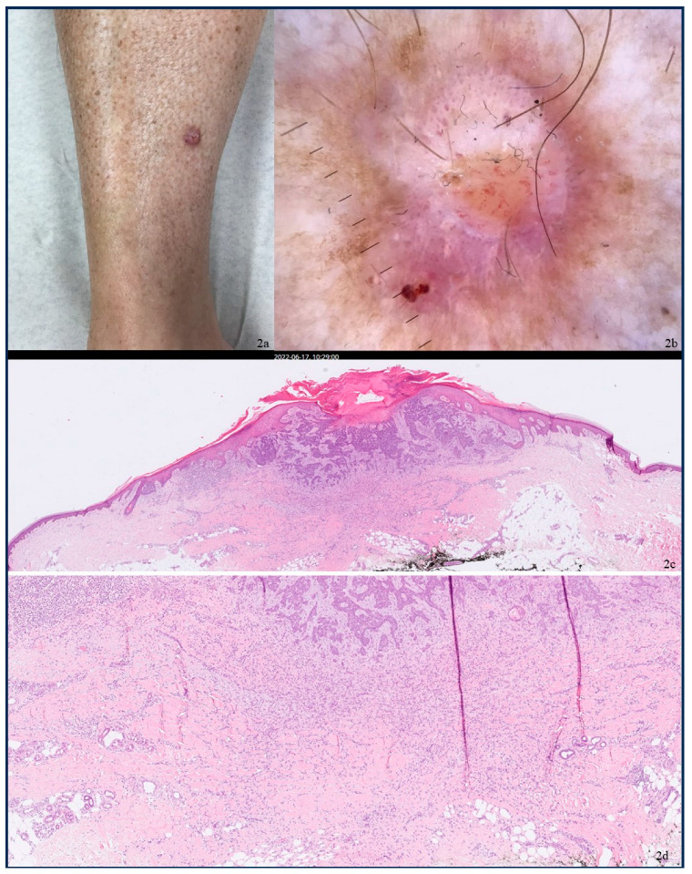 Uncommon Collision Tumors: Dermoscopic and Histopathological Features of Basal Cell Carcinoma Overlying Dermatofibroma.