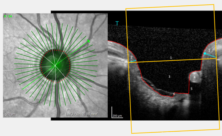 Estimation of normal and glaucomatous optic nerve morphology from perfusion.