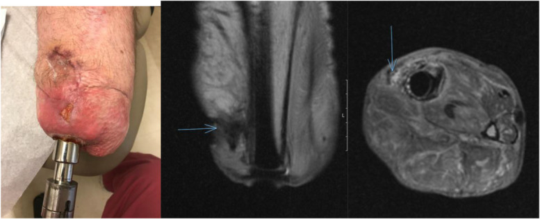 Consensus statement on the prevention, diagnosis, and management of infection following transcutaneous osseointegration for patients with limb loss: current state-of-the-art and proposed future studies.