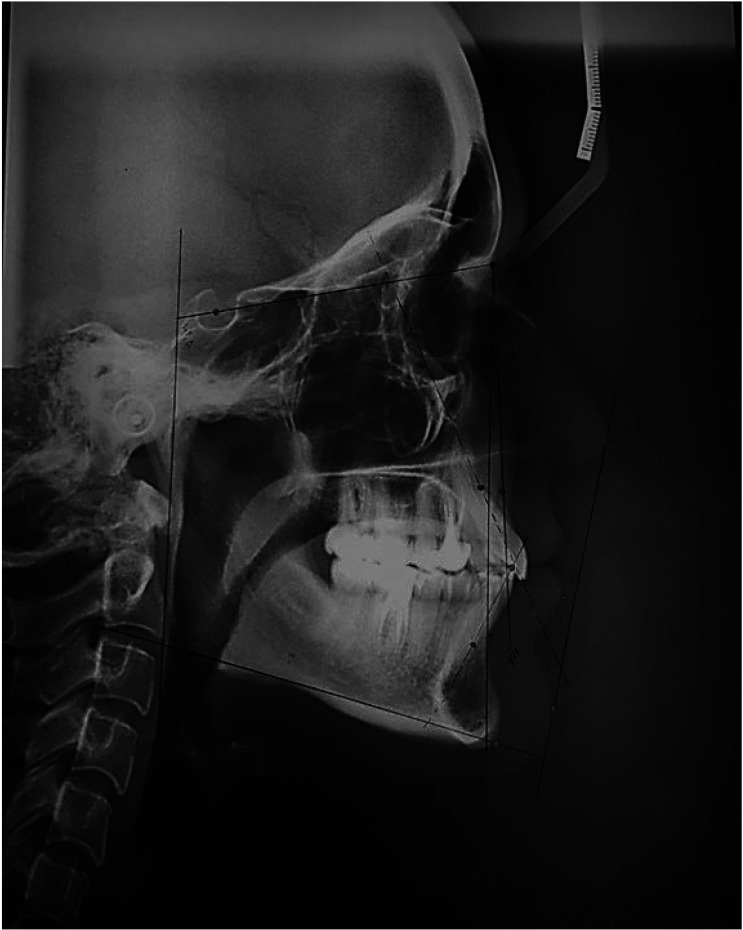 Comparative accuracy of artificial intelligence-based AudaxCeph software, Dolphin software, and the manual technique for orthodontic landmark identification and tracing of lateral cephalograms.