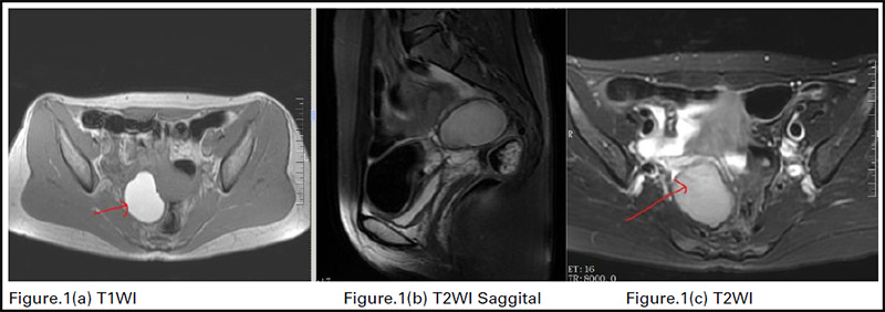 Current Status and Future Potential of Machine Learning in Diagnostic Imaging of Endometriosis : A Literature Review.