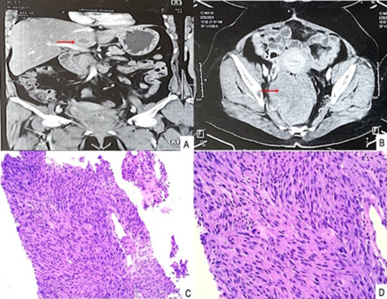 Cytological Diagnosis of Hepatic Metastasis from Rectal Gastrointestinal Stromal Tumor: A Case Report.