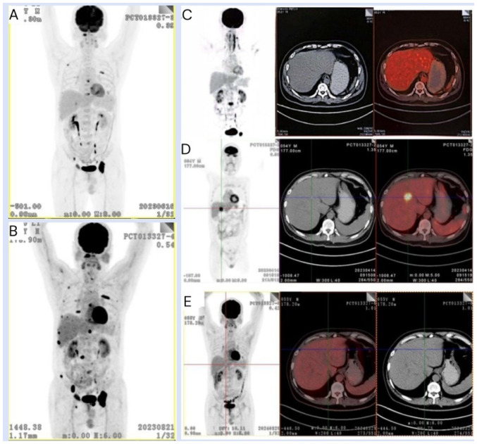Achieving stringent complete remission in relapsed/refractory multiple myeloma with liver extramedullary disease after CAR‑T cell therapy: A case report.