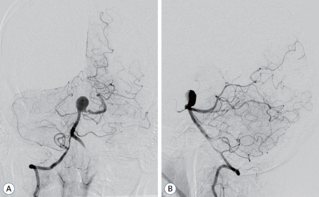 Strategic Dual Approach for the Management of a Symptomatic Giant Partially Thrombosed Aneurysm at the Basilar Tip - Integrating Intrasaccular Flow Diversion and Endovascular Flow Reversal.