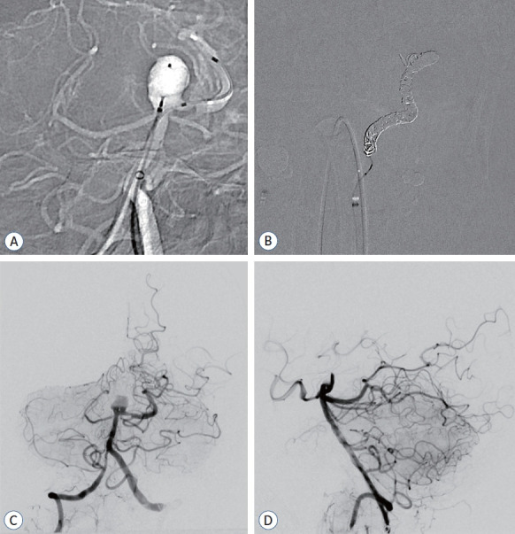 Strategic Dual Approach for the Management of a Symptomatic Giant Partially Thrombosed Aneurysm at the Basilar Tip - Integrating Intrasaccular Flow Diversion and Endovascular Flow Reversal.