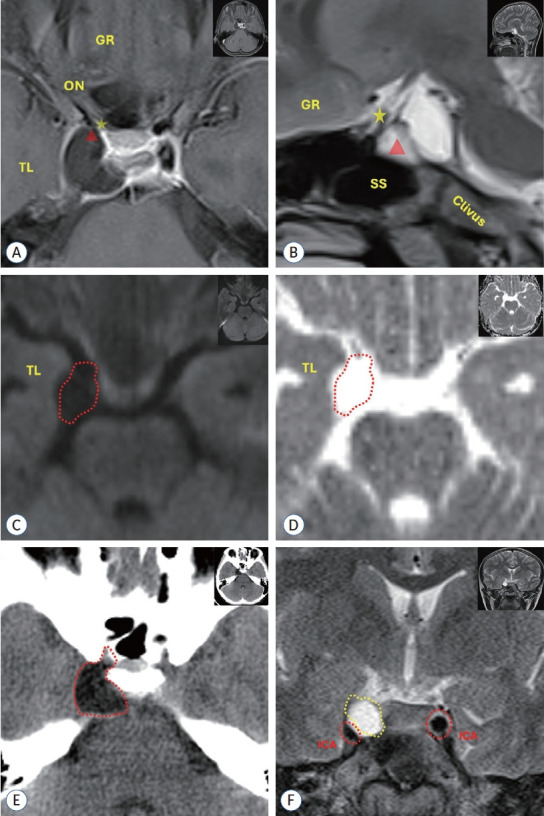 A Parasellar Hydatid Cyst Extending to the Opticocarotid Triangle, Pediatric Case.