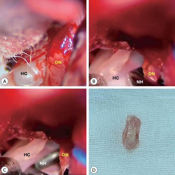 A Parasellar Hydatid Cyst Extending to the Opticocarotid Triangle, Pediatric Case.
