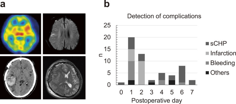Systemic Immune-inflammation Index Is Associated with Symptomatic Cerebral Hyperperfusion after Revascularization Surgery in Moyamoya Disease.