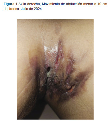 [Hidradenitis suppurativa, report with dual therapy: small molecules and biological therapy].