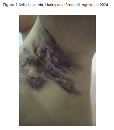 [Hidradenitis suppurativa, report with dual therapy: small molecules and biological therapy].