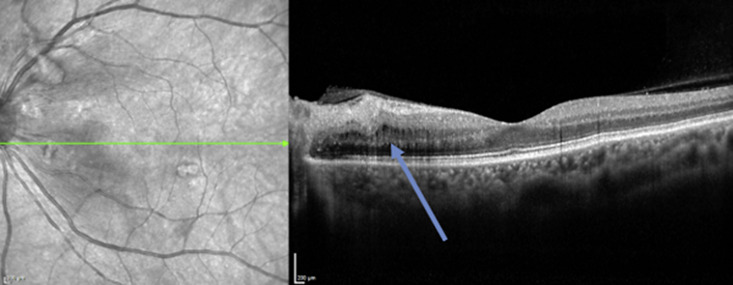 Coincidence of Takayasu Arteritis and Multiple Sclerosis: Narrative Review and Case Report.