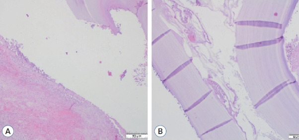 A Parasellar Hydatid Cyst Extending to the Opticocarotid Triangle, Pediatric Case.