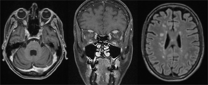 Coincidence of Takayasu Arteritis and Multiple Sclerosis: Narrative Review and Case Report.