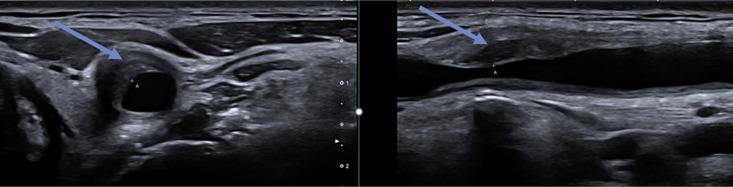 Coincidence of Takayasu Arteritis and Multiple Sclerosis: Narrative Review and Case Report.