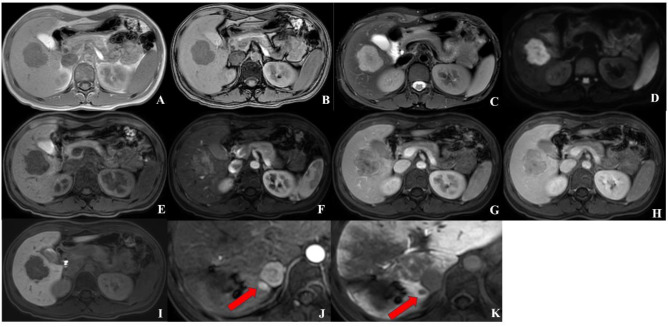 Diagnostic model using LI-RADS v2018 for predicting early recurrence of microvascular invasion-negative solitary hepatocellular carcinoma.